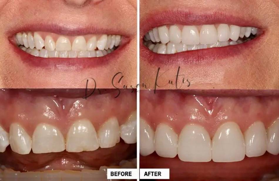 Cosmetic Dentistry Gallery Littleton